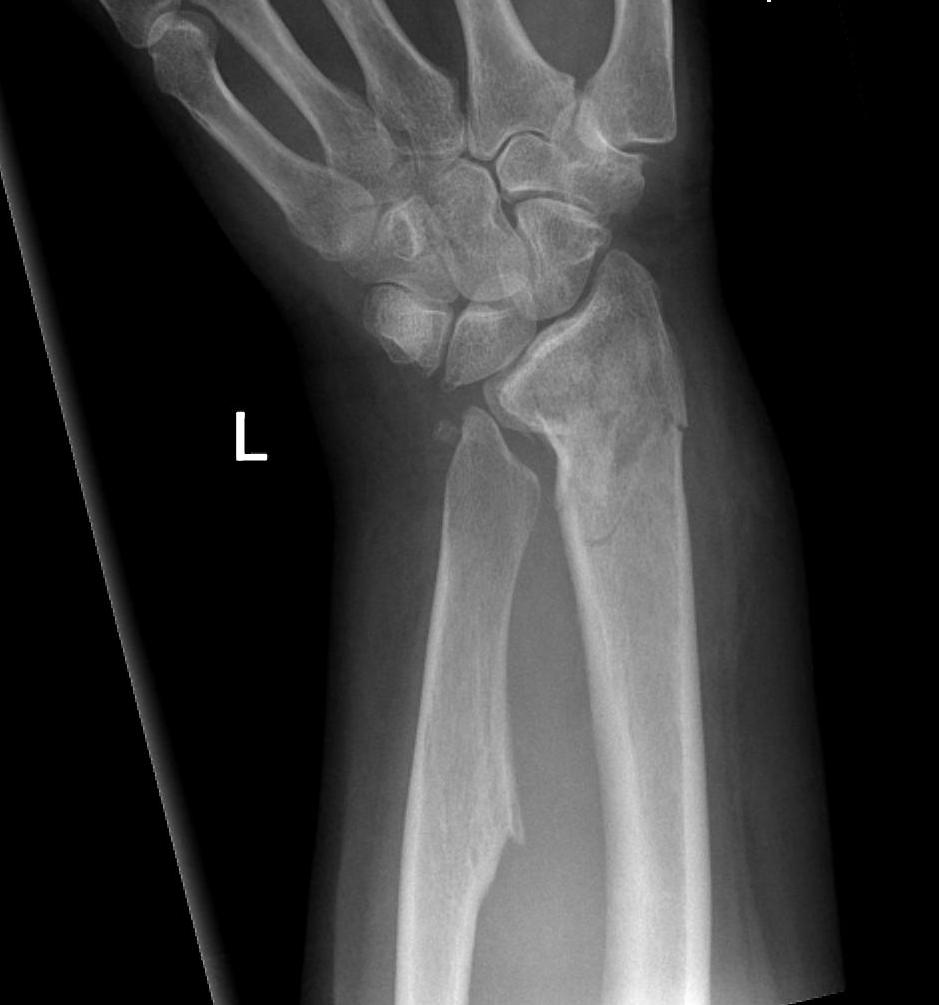 Madelung's deformity with fracture